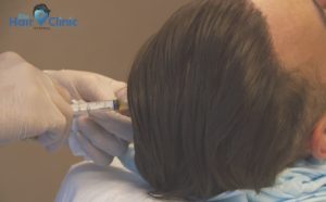 PRP treatment with Bio Hair Clinic