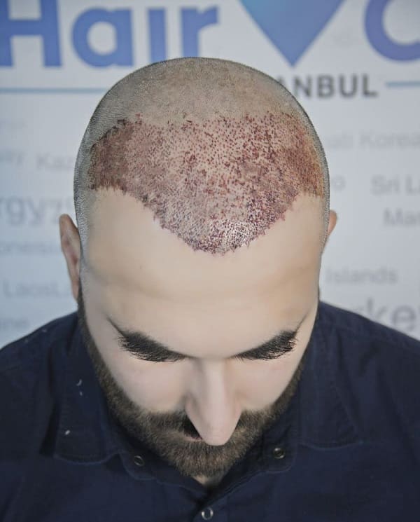 Fue Hair Transplant The Best Hair Loss Treatment In Turkey