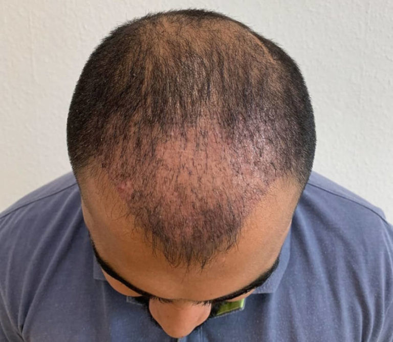 When does hair grow back after a hair transplant? Bio Hair Clinic