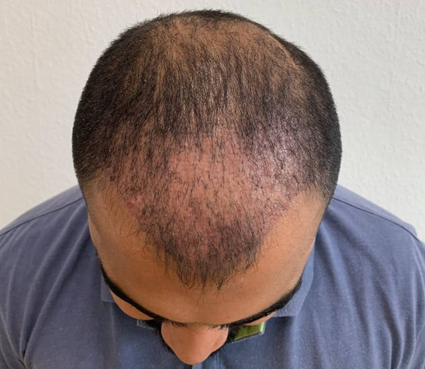 When does hair grow back after a hair transplant? Bio Hair Clinic