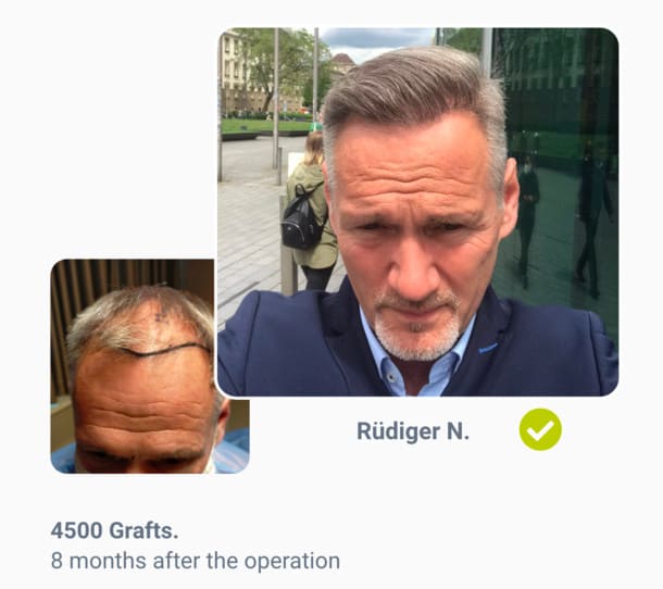 Patient Rüdiger in hair transplant before after comparison