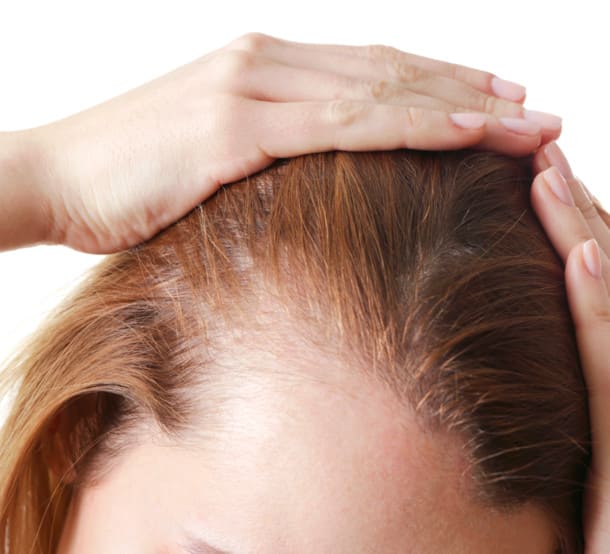 when to have a hair transplant for women