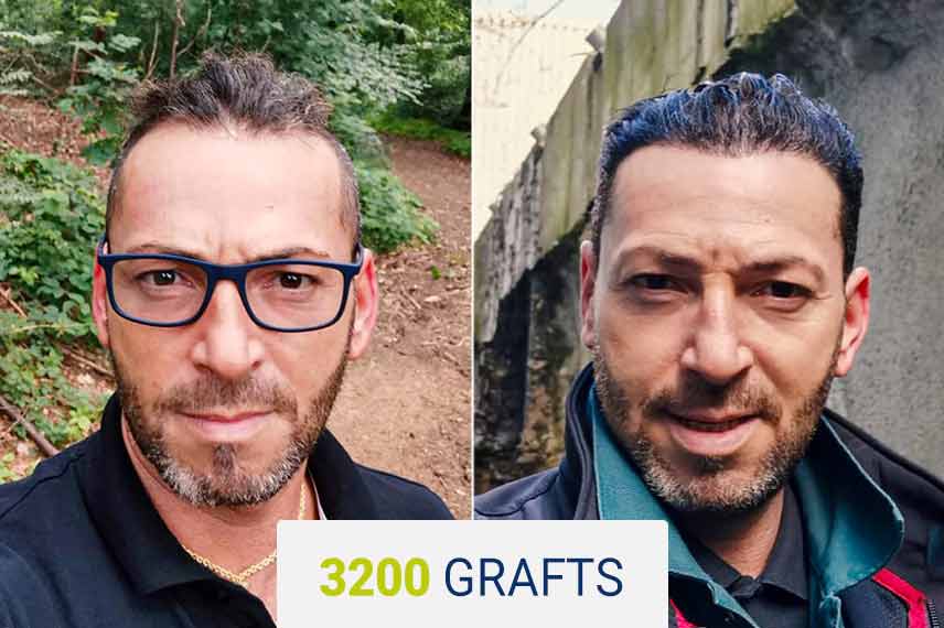 Before and After Sapphire Hair Transplantation 3200 grafts Tygay Tas