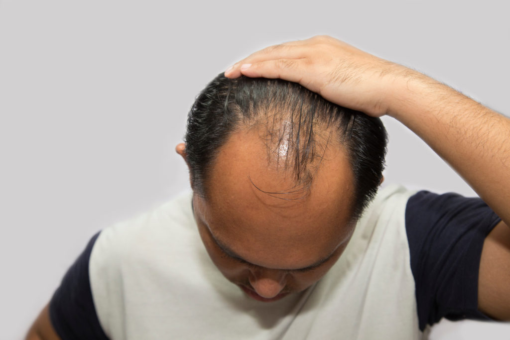 Close up of a man showing his hairline receding to his crown