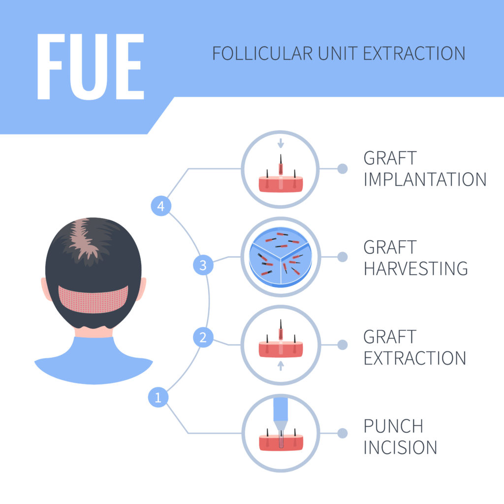 An illustration of the FUE hair transplant procedure