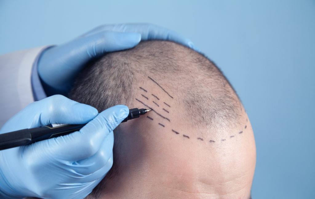 A doctor drawing a new hairline onto a male patient