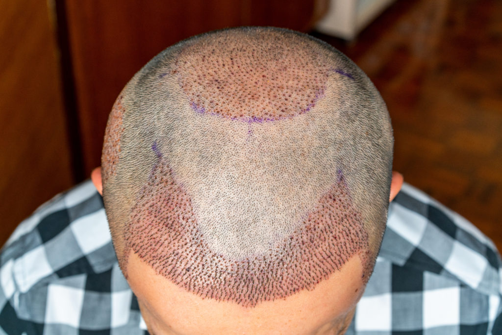 the view from the top of a man's head after he’s had a hair transplant