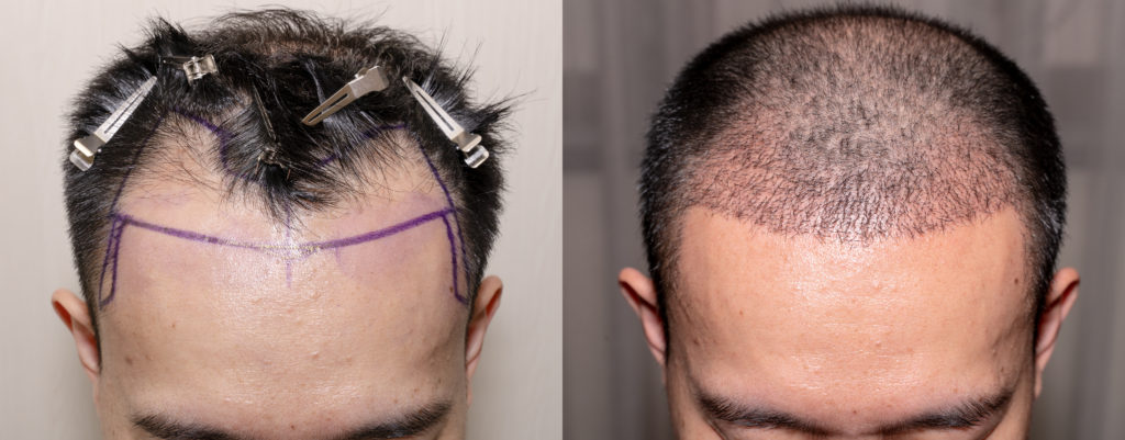 Before and after images of a hair restoration