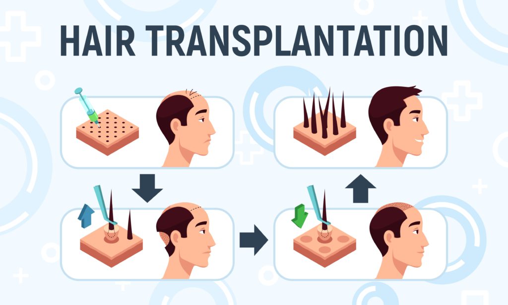 An illustration of hair transplantation using the FUE technique