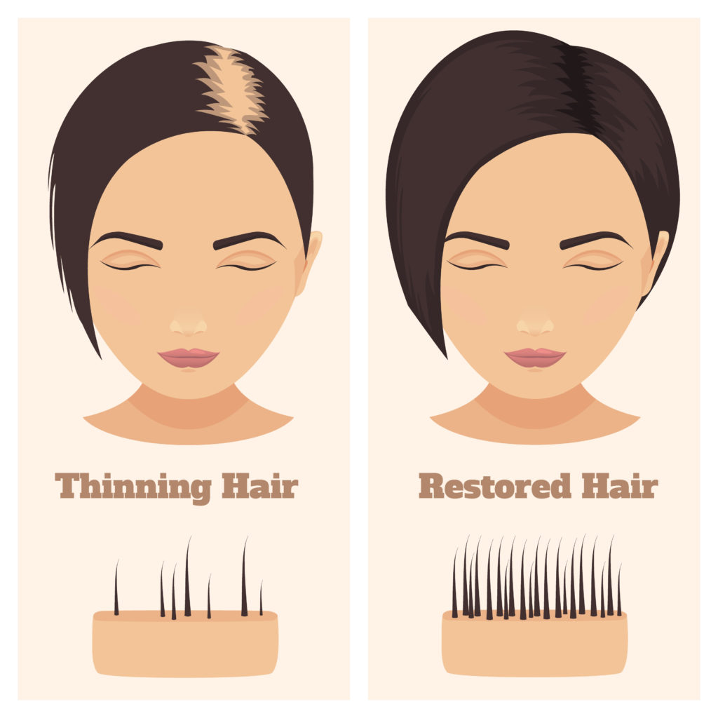 An illustration of a woman's hair before and after hair loss