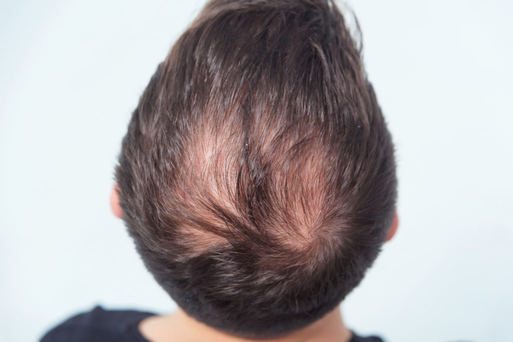 Back of a man's head highlighting bald spot developing