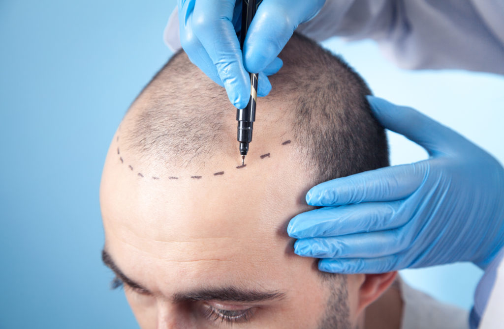 A patient in consultation with a hair transplant doctor