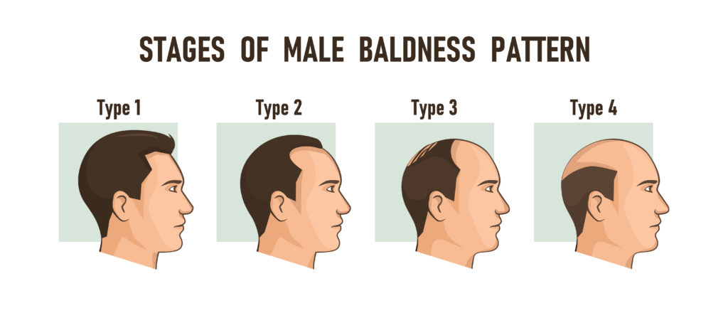 An illustration of the stages of male pattern baldness