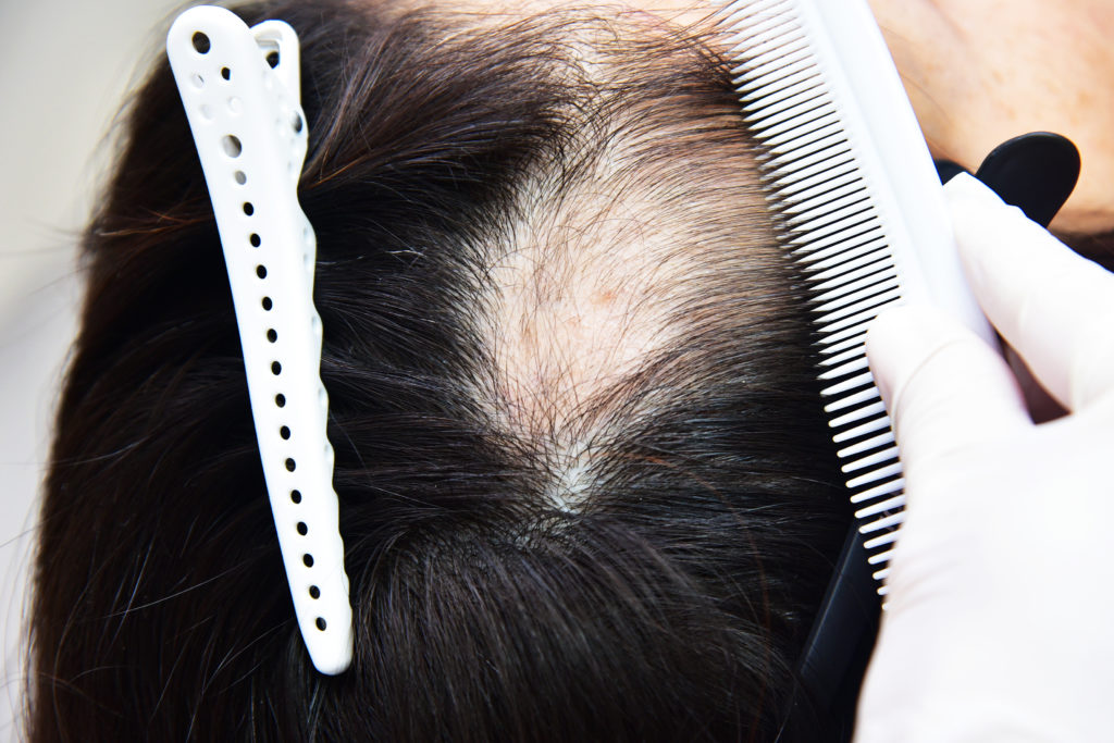 Patchy baldness on the top of a woman's head 