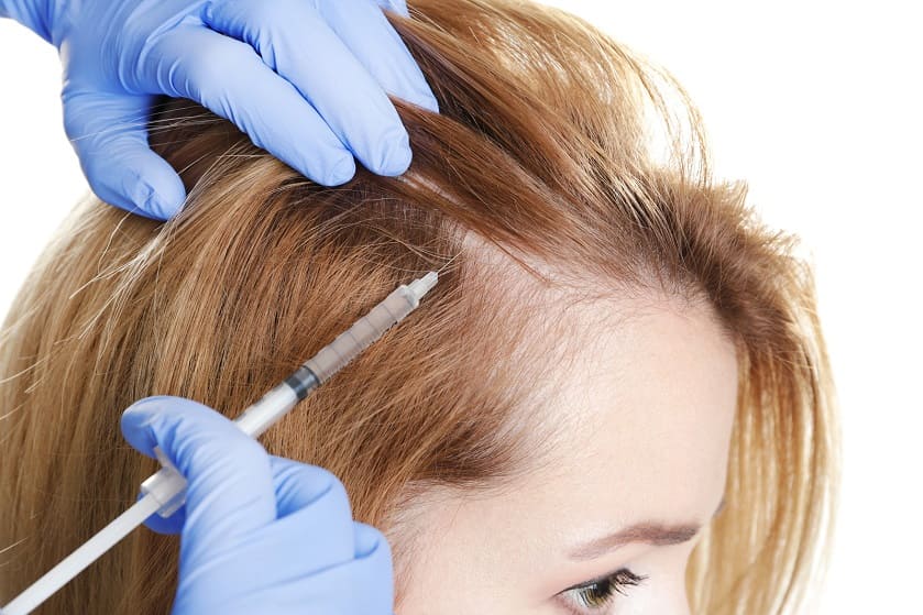 Trasplante capilar Bio FUE para mujeres