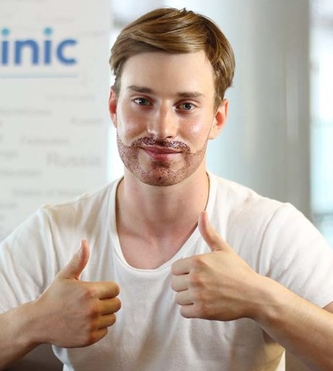 Paciente de trasplante de barba - Bio Hair Clinic Paciente de Trasplante de barba
