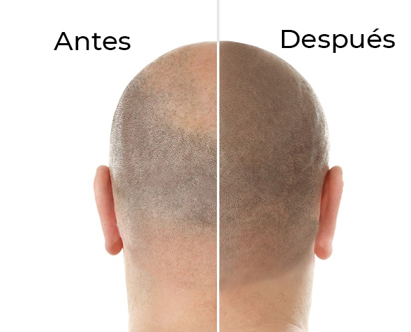 Foto de Antes y Después de la pigmentación capilar Antes y Después - Pigmentación Capilar