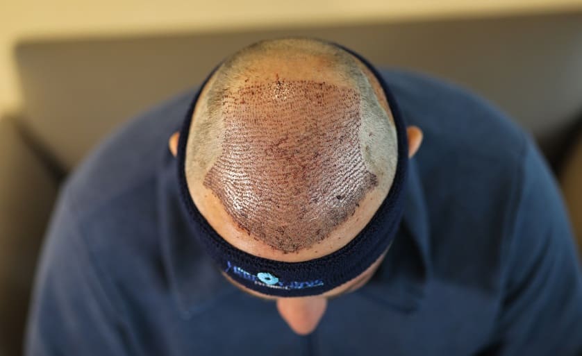 Paciente tras recibir implante de 4900 unidades foliculares
