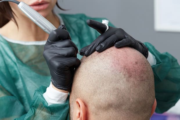 Hombre recibiendo tratamiento de pigmentación capilar Pigmentación Capilar