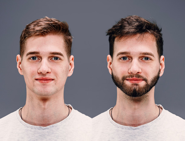 Imagen de un paciente Antes y después de un implante de barba #