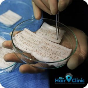 FUE Haartransplantation FUE Haartransplantation