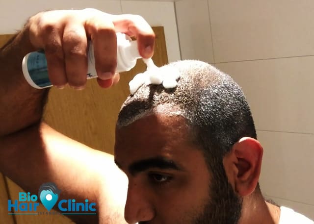 post trapianto capelli lo shampoo