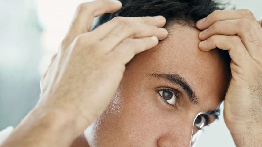 uomo soffre di caduta dei capelli a causa della psoriasi del cuoio capelluto