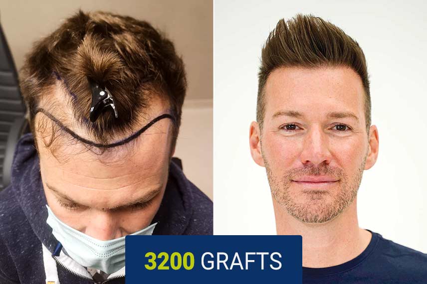 prima e dopo del trapianto di capelli DHI da 3200 innesti di Manuel Burger