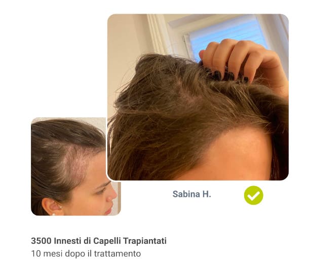 Foto prima e dopo il trapianto di capelli da 3500 innesti di Sabina H