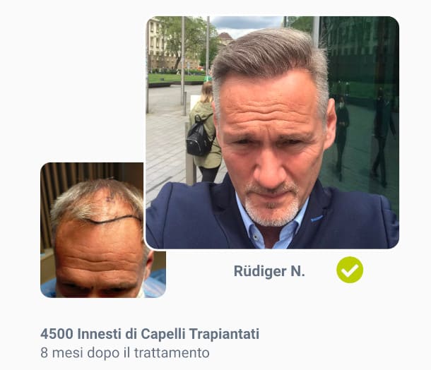 Foto prima e dopo il trapianto di capelli da 4500 innesti di Rüdiger N.
