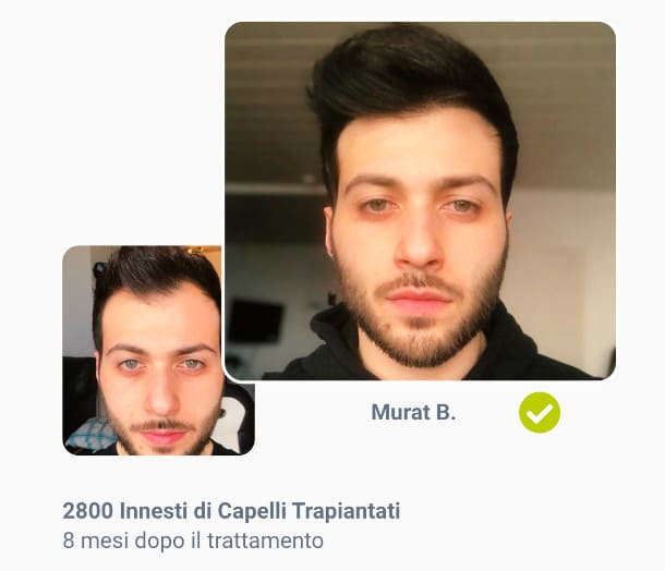 foto prima e dopo il trapianto di capelli da 2800 innesti di di Murat B.