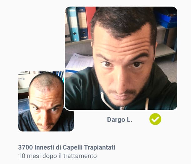 foto prima e dopo il trapianto di capelli da 3700 innesti di di Dargo L.