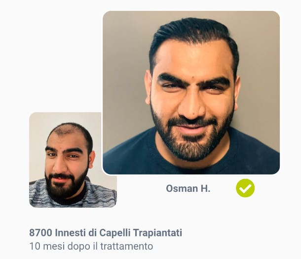 foto prima e dopo il trapianto di capelli da 8700 innesti di di Osman H.