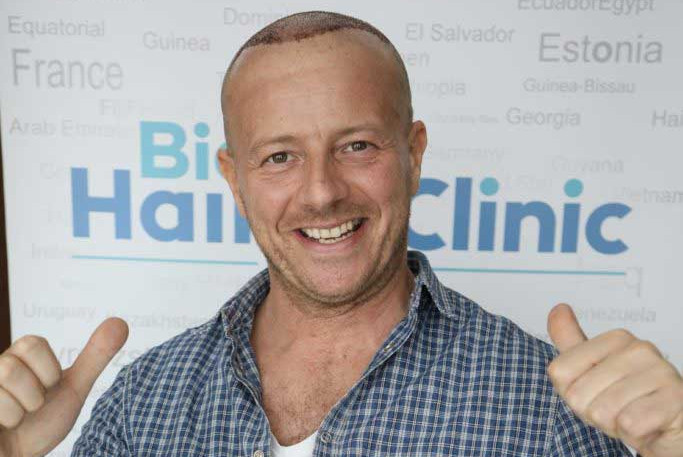 Haartransplantation Türkei Erfahrungen 2017 – die Ergebnisse