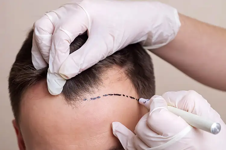 Ein Mann wird vor einer Haartransplantation behandelt. Auf einer Stirn am Haaransatz wird mit einem Stift eine Linie gezogen