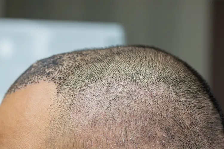 Auf der Kopfhaut eines Mannes haben sich nach der Haarimplantation Krusten gebildet. 