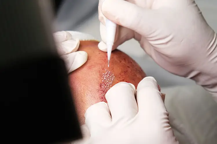 Mit dem sogenannten Choi Stift werden die Haare einzeln in die Kopfhaut eines Patienten implantiert