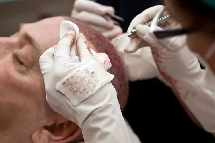 Einem Mann werden während seiner Haarverpflanzung die einzelnen Haarfollikel aus der Kopfhaut entnommen.