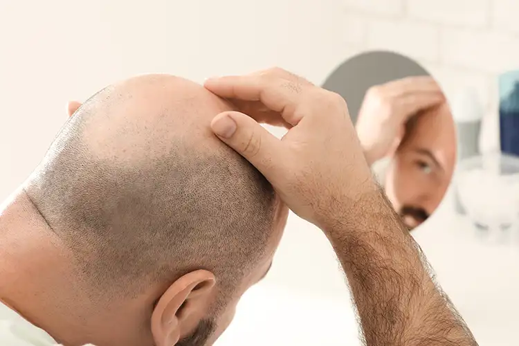 Ein Mann mit rasierten Hinterkopf und Glatze schaut in den Spiegel und fasst sich an den Kopf.