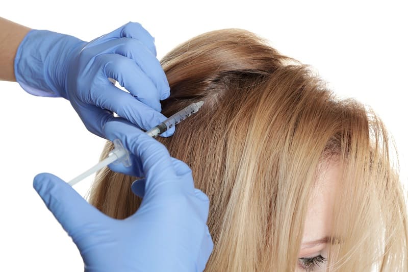 Haartransplantation die Haarlinie korrigieren - PRP-Behandlung