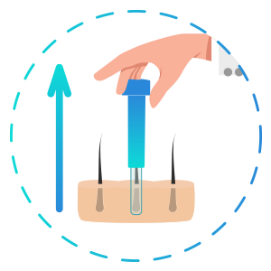 DHI Haartransplantation - Grafts Entnehmen