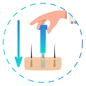 DHI Haartransplantation - Graft einpflanzen
