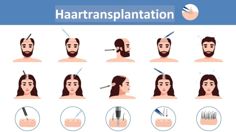 Haartransplantationsmethode - Haartransplantationstechniken