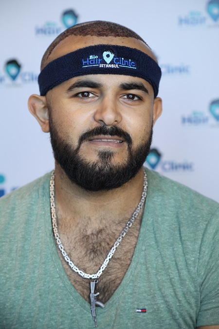 Haartransplantation-Narben mit dem FUE-Verfahren Haartransplantation-Narben mit dem FUE-Verfahren