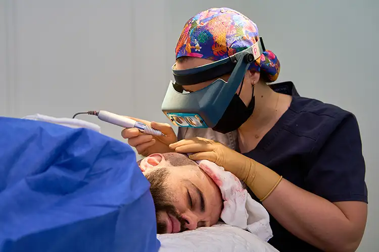 Die Entnahme der Haarfollikel während einer Haartransplantation wird bei einem Mann durchgeführt