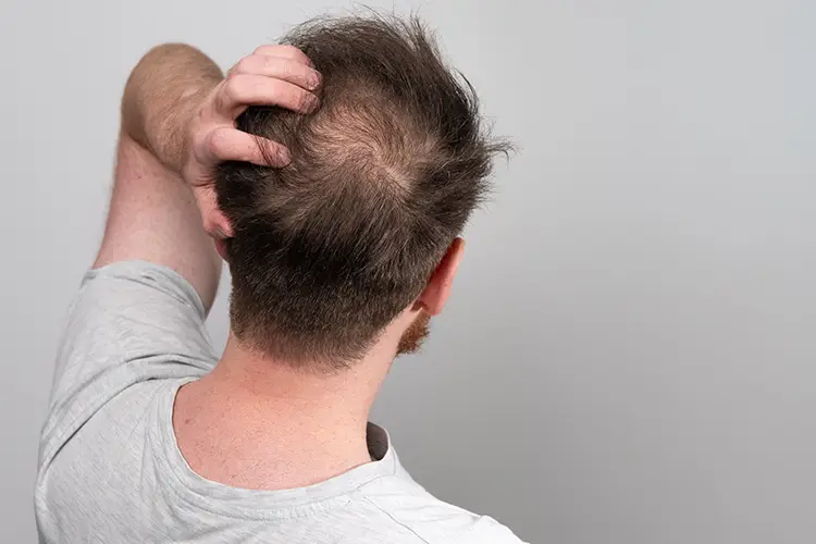 Ein Mann fasst sich mit einer Hand durch seine Haare. An seinem Hinterkopf sind bereits sehr lichte Stellen zu erkennen.