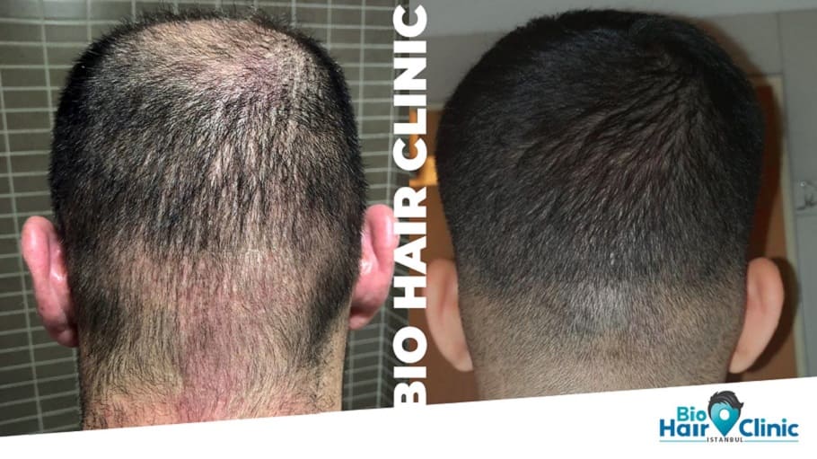 Spenderbereich nach Haartransplantation