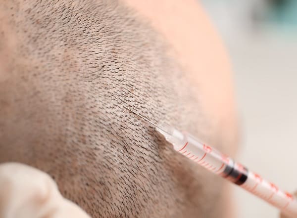 Wie lange dauert eine Haartransplantation - PRP Therapie