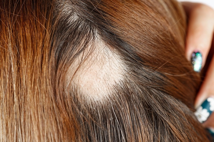 Nahaufnahme eines Frauenhinterkopfs mit kreisrundem Haarausfall