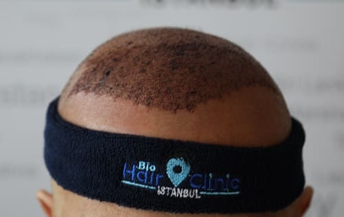 Haartransplantation Stirnband entfernen Rücksprache mit Arzt